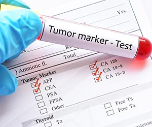 tumor-markers_300X250.jpg